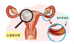 <b>女性朋友怎样才能知道自己是不是输卵管堵塞了？</b>