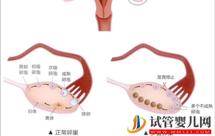 多囊卵巢会引起卵泡过多