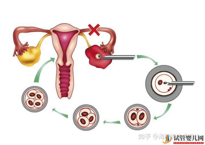 试管婴儿网:试管婴儿1代、2代、3代、4代哪个最好(图2)