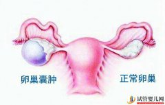 有卵巢囊肿可以做试管婴儿吗？