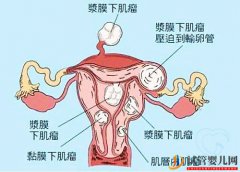 多发性子宫肌瘤可以做试管婴儿吗？你都了解吗