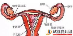 输卵管堵塞还想怀宝宝!能够做泰国试管婴儿吗